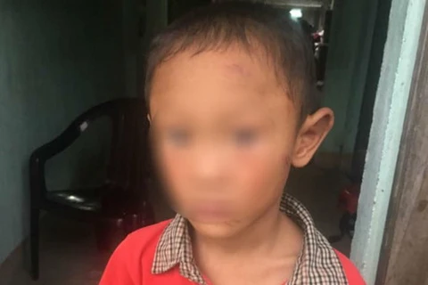 Bé trai 5 tuổi bị dì ruột đánh đập dã man gây thương tích nặng