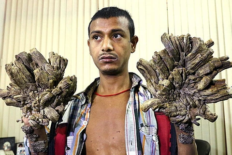 Abul Bajandar với đôi bàn tay "vỏ cây." (Nguồn: telegraph.co.uk)