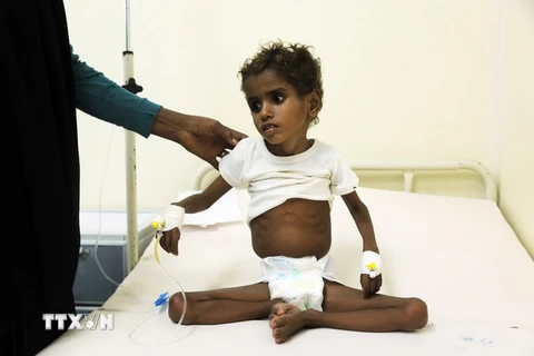 Điều trị cho một em bé bị suy dinh dưỡng ở thành phố cảng Hodeidah, Yemen ngày 5/11. (Nguồn: AFP/TTXVN)