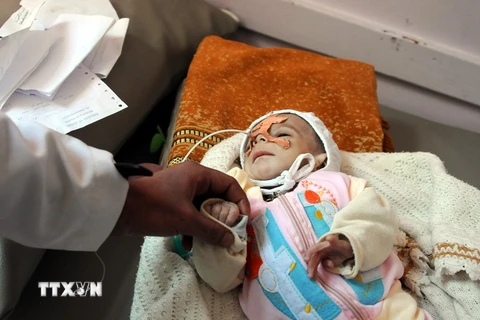 Trẻ em Yemen bị suy dinh dưỡng điều trị tại bệnh viện ở Sanaa. (Nguồn: THX/TTXVN)