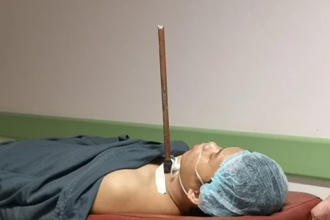Bệnh nhân D. nằm trong phòng phẫu thuật với mũi chĩa còn đâm vào vùng cổ. (Nguồn: thanhnien.vn)