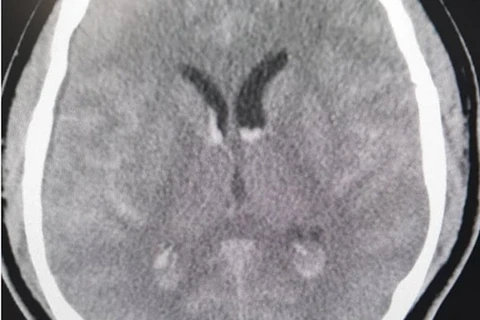 Hình ảnh phim chụp xuất huyết dưới nhện lan tỏa - tụ máu não thất của bệnh nhân Hàn Quốc. (Nguồn: nhandan.com.vn)