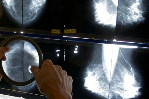 Bác sỹ X-quang sử dụng kính lúp để kiểm tra nhũ ảnh để phát hiện ung thư vú. (Nguồn: AP)