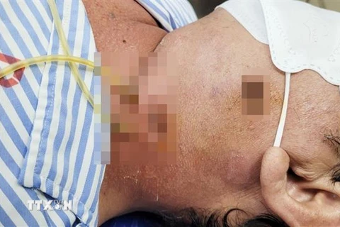 Hình ảnh cổ bệnh nhân sau phẫu thuật được cắt bỏ khối áp xe. (Ảnh: Chanh Đa/TTXVN)
