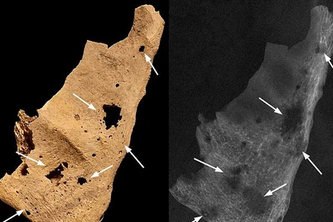 Phát hiện dấu vết bệnh ung thư ở hài cốt 3.200 năm tuổi