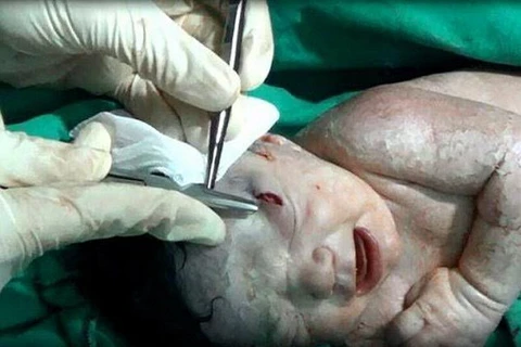 Mảnh đạn trên đầu em bé đã được gắp ra. (Nguồn: dailymail.co.uk)