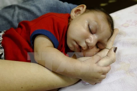 Một em bé bị chứng đầu nhỏ liên quan tới virus Zika. (Nguồn: THX/TTXVN)