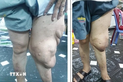 Một bệnh nhân dị dạng “chân voi” trước và sau phẫu thuật. (Nguồn: TTXVN)