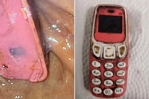 Chiếc điện thoại được lấy ra từ trong bụng người đàn ông. (Nguồn: metro.co.uk)