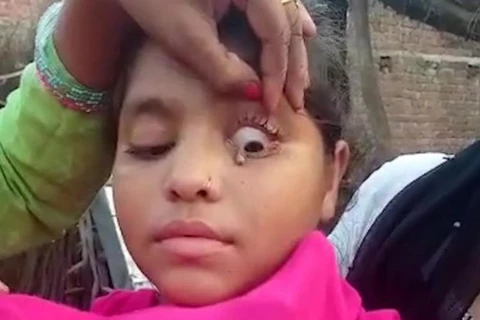 Bé gái Ấn Độ khóc ra những viên đá nhỏ. (Nguồn: odditycentral.com)