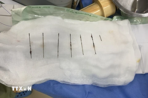 7 cây kim được các bác sỹ phẫu thuật gắp ra khỏi lồng ngực bệnh nhân. (Ảnh: TTXVN phát)