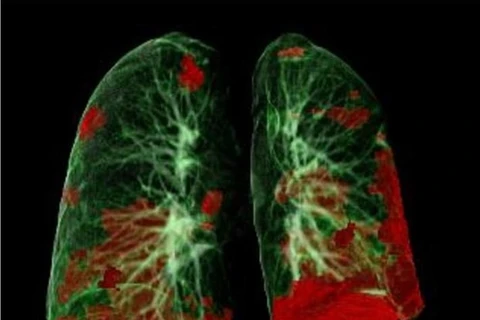 Chụp CT phổi của bệnh nhân cho thấy tổn thương COVID-19 màu đỏ. Ảnh minh họa. (Nguồn: healthcare-in-europe.com)