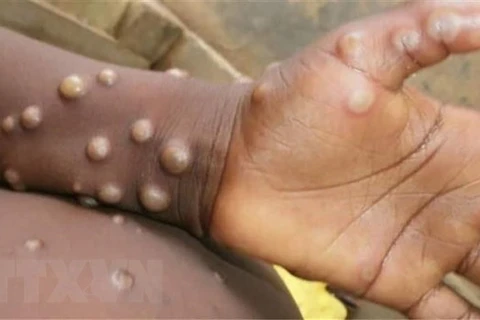 Các phần bị tổn thương xuất hiện trên tay và chân em nhỏ bị nghi mắc bệnh đậu mùa khỉ. (Ảnh: Getty Images/TTXVN) 