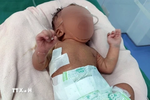 Sức khỏe bé gái sơ sinh 3 ngày tuổi (trú huyện Đăk Hà, tỉnh Kon Tum) bị teo thực quản bẩm sinh đã ổn định. (Ảnh: TTXVN phát)