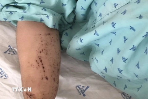 Bệnh nhân 19 tuổi, ngụ phường Mỹ Thới, thành phố Long Xuyên, tỉnh An Giang bị đứt lìa bàn tay phải do pháo tự chế nổ. (Ảnh: TTXVN phát)