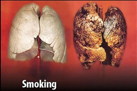 Nepal: Hình ảnh cảnh báo sức khỏe chiếm 90% diện tích vỏ bao thuốc lá