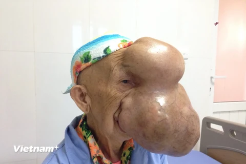 Triệu Mùi Chài với khối u khổng lồ trên mặt. (Ảnh:T.G/Vietnam+)