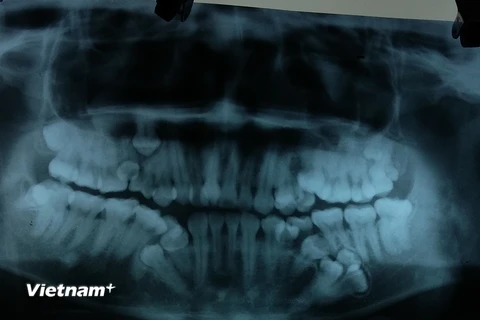 Phim chụp hình ảnh những răng thừa của bệnh nhân ở cả hai hàm. (Ảnh: PV/Vietnam+)