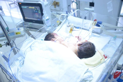Hai bé song sinh dính liền nhau đang điều trị tại Bệnh viện Việt Đức. (Ảnh: PV/Vietnam+)
