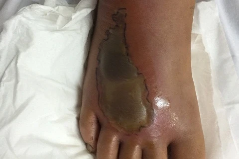 Bàn chân của một bệnh nhi bị rắn cắn. (Ảnh: PV/Vietnam+)