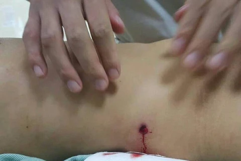 Hình ảnh viên đạn đâm vào bụng bệnh nhân. (Nguồn: Bệnh viện E)