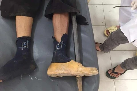 Chiếc xà beng đâm xuyên bàn chân của nạn nhân. (Ảnh: PV/Vietnam+)