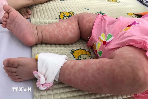 [Video] Nhiều trẻ mắc bệnh sởi do chưa được tiêm chủng
