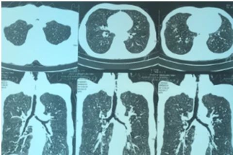 Hình ảnh chụp CT ngực của bệnh nhân cho thấy có tình trạng hẹp khí quản ở đoạn 1/3 trên. (Ảnh: BV cung cấp)