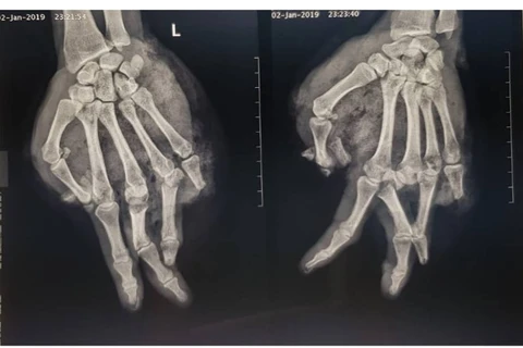 Ảnh chụp phim X-quang bàn tay của bệnh nhân. (Ảnh: BVCC)