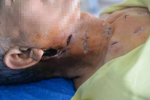 Bệnh nhân với những tổn thương ở vùng cổ, ngực. (Ảnh: PV/Vietnam+)
