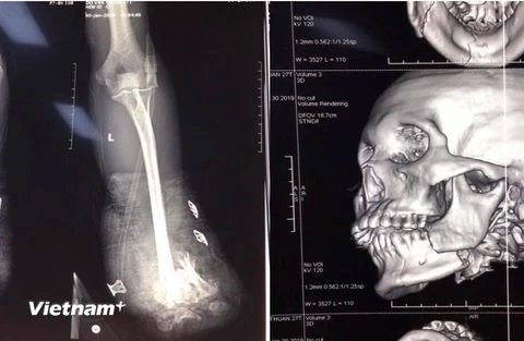 Hình ảnh chụp X-quang về tai nạn thương tích của một bệnh nhân bị tai nạn do pháo nổ tại Bệnh viện Trung ương Quân đội 108. (Ảnh: PV/Vietnam+)