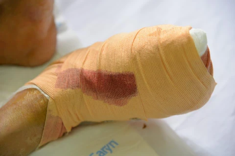 Một bệnh nhân với vết thương nặng ở bàn chân. (Ảnh: PV/Vietnam+)