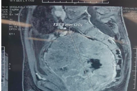Hình ảnh chụp khối u của bệnh nhân. (Ảnh: PV/Vietnam+)
