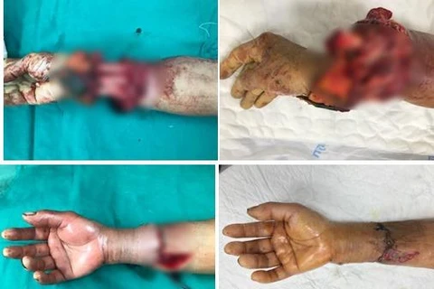 Cánh tay của bệnh nhân bị đứt rời do máy tuốt lúa. (Ảnh: PV/Vietnam+)