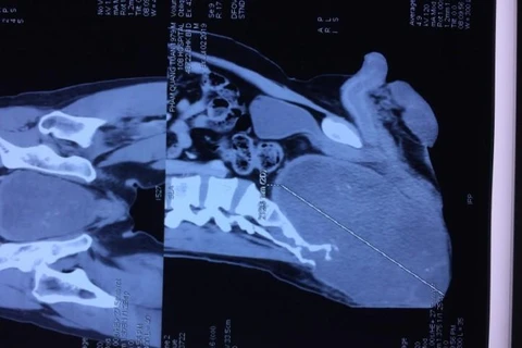 Phim chụp khối u của bệnh nhân. (Ảnh: PV/Vietnam+)