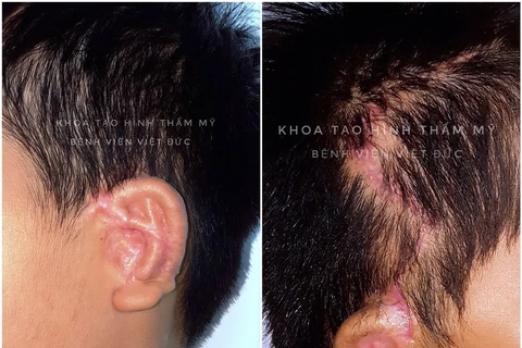 Các bác sỹ thực hiện phẫu thuật tạo hình tai nhỏ bằng sụn sườn tự thân cho bệnh nhân. (Ảnh: PV/Vietnam+)