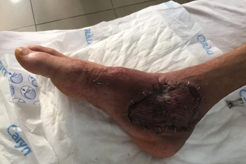 Chân của bệnh nhân sau khi được điều trị. (Ảnh: PV/Vietnam+)