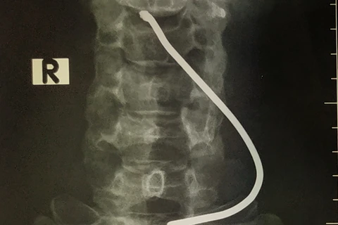 Hình ảnh chiếc thanh sắt cắm vào cổ bệnh nhân. (Ảnh: PV/Vietnam+)