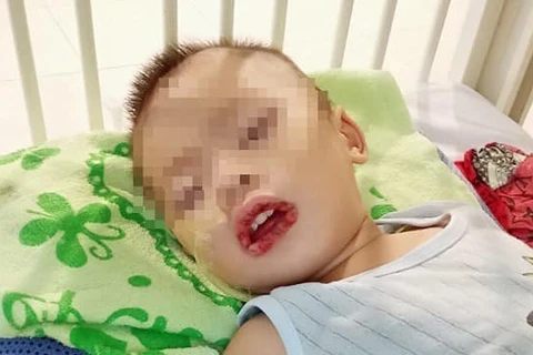 Bệnh nhân nhập viện với tổn thương vùng miệng và hạ họng thanh môn phù nề xung huyết. (Ảnh: PV/Vietnam+)