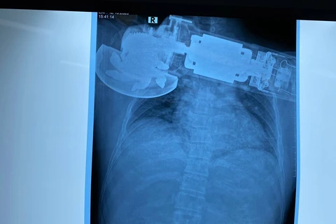 Hình ảnh chụp X-Quang chiếc máy găm vào ngực của bệnh nhân. (Ảnh: PV/Vietnam+)