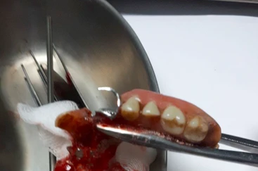 Cứu sống người bệnh nuốt cả hàm răng giả vào thực quản 
