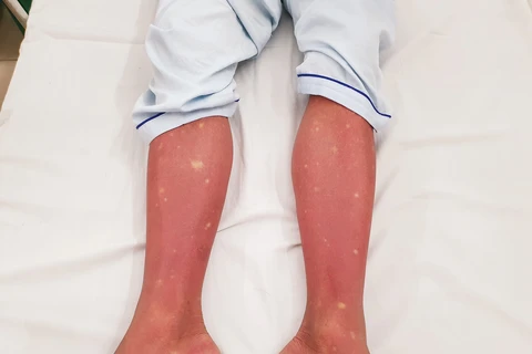 Hình ảnh xuất huyết trên chân của bệnh nhân sốt xuất huyết. (Ảnh: PV/Vietnam+)