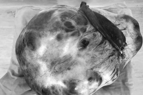 Người phụ nữ mang khối u buồng trứng “siêu khổng lồ” nặng 13kg