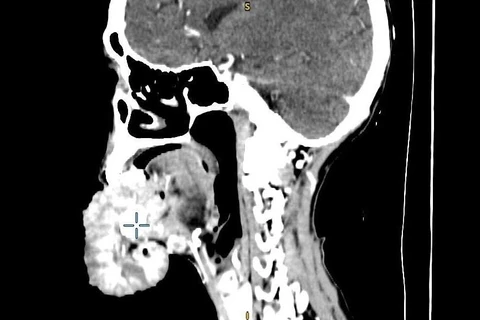 Phim chụp khối u của bệnh nhân. (Ảnh: PV/Vietnam+)