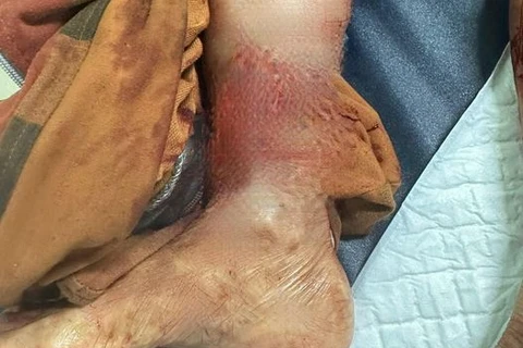Cẳng chân của bệnh nhân bị chó cắn. (Ảnh: BVCC)