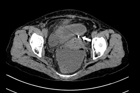 Hình ảnh chụp cắt lớp vi tính. Dụng cụ tử cung xuyên qua thành tử cung vào ruột (mũi tên trắng). (Ảnh: BVCC)
