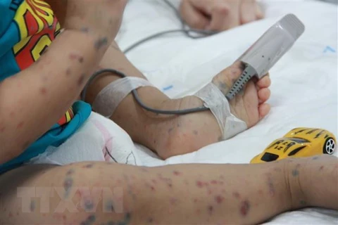 Một trẻ mắc bệnh tay chân miệng. (Ảnh: TTXVN/Vietnam+)
