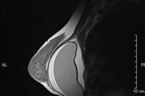 Hình ảnh chụp MRI ngực của một bệnh nhân tại Bệnh viện Đại học Y Hà Nội. (Ảnh: BVCC)