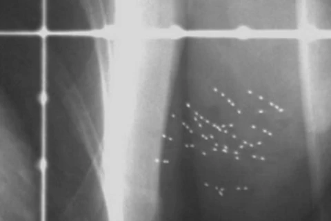 Hình ảnh chụp X-quang các hạt phóng xạ được cấy trong vú của một bệnh nhân. (Nguồn: cbc.ca)