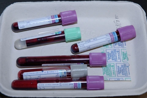 Thử máu thường xuyên giúp phát hiện sớm ung thư buồng trứng